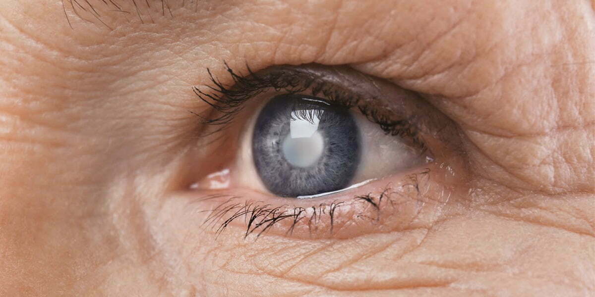 Cataracte, symptômes, traitements Dr Ihaddadene Ophtalmologue à Blida