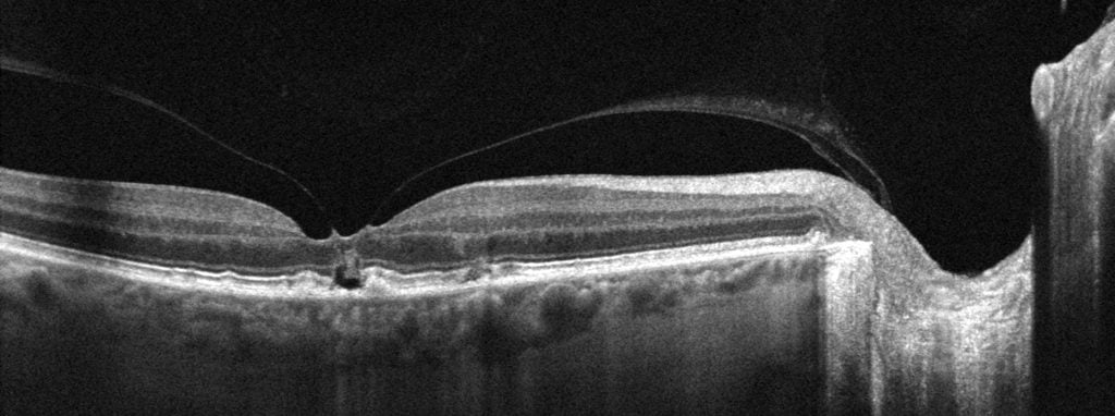 La tomographie en cohérence optique (Optical Coherence Tomography = OCT)​ clinique d'ophtalmologie Oculus du médecin ophtalmologue Dr Rezki Ihaddadene à Blida en Algérie