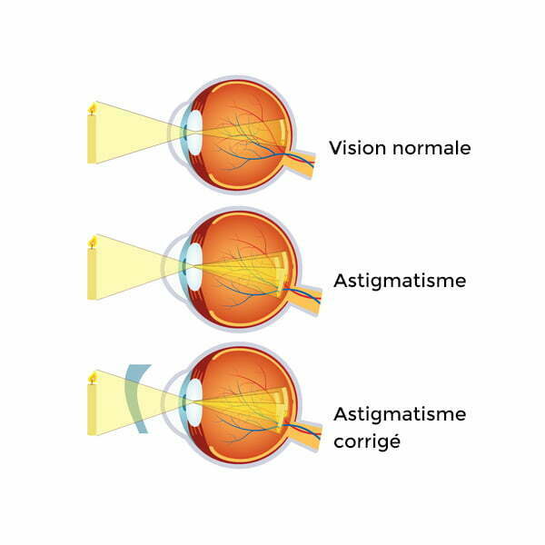 Type d'astigmatisme, Astigmatisme myopique symptômes et traitement a la clinique d'ophtalmologie Oculus chez dr Ihaddadene, Ophtalmologue à Blida en Algérie