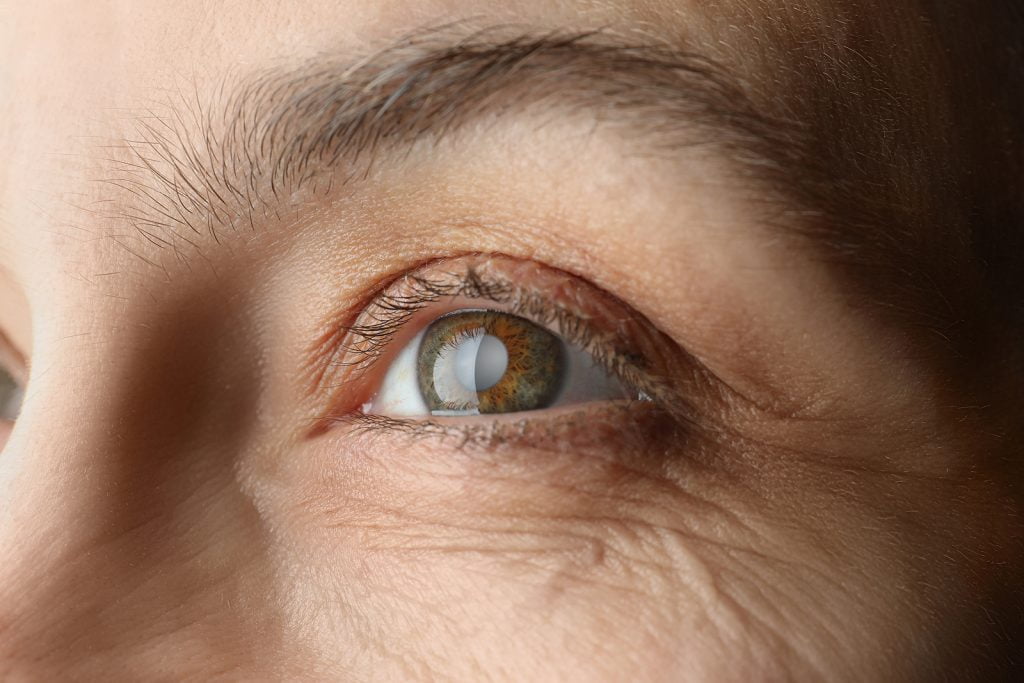 La cataracte, types, causes, symptômes et traitements